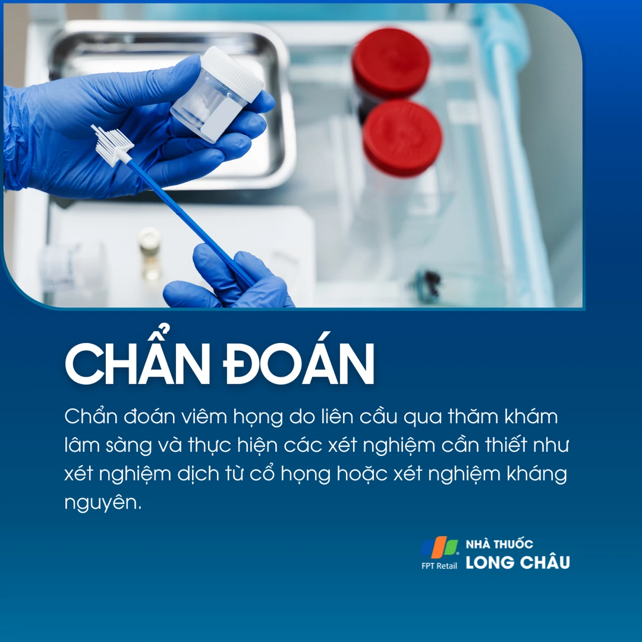 Viêm họng do liên cầu 5