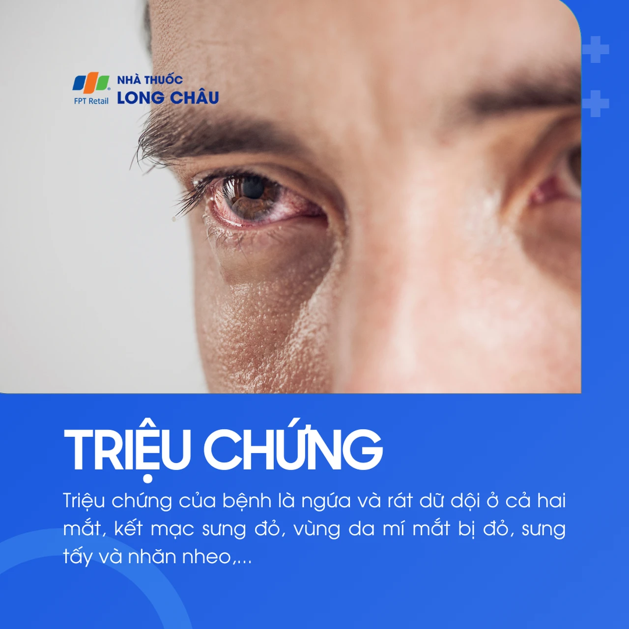 Viêm kết mạc dị ứng 2