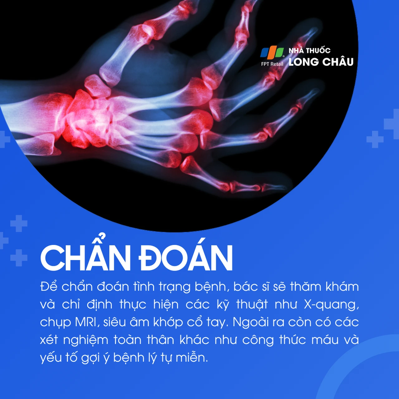 Viêm khớp cổ tay 5