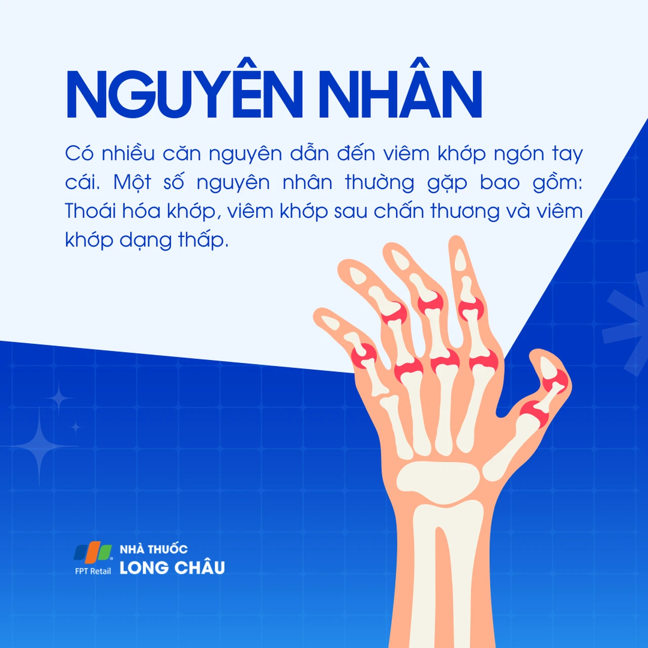 Viêm khớp ngón tay cái 3