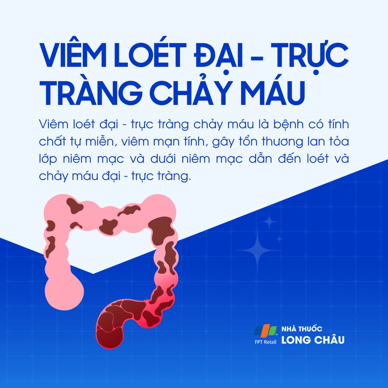Viêm loét đại - trực tràng chảy máu 1