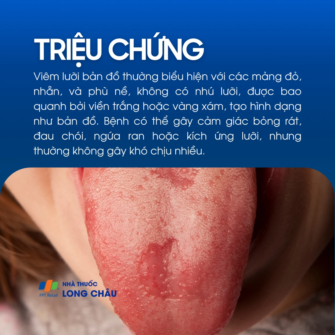 Viêm lưỡi bản đồ 2