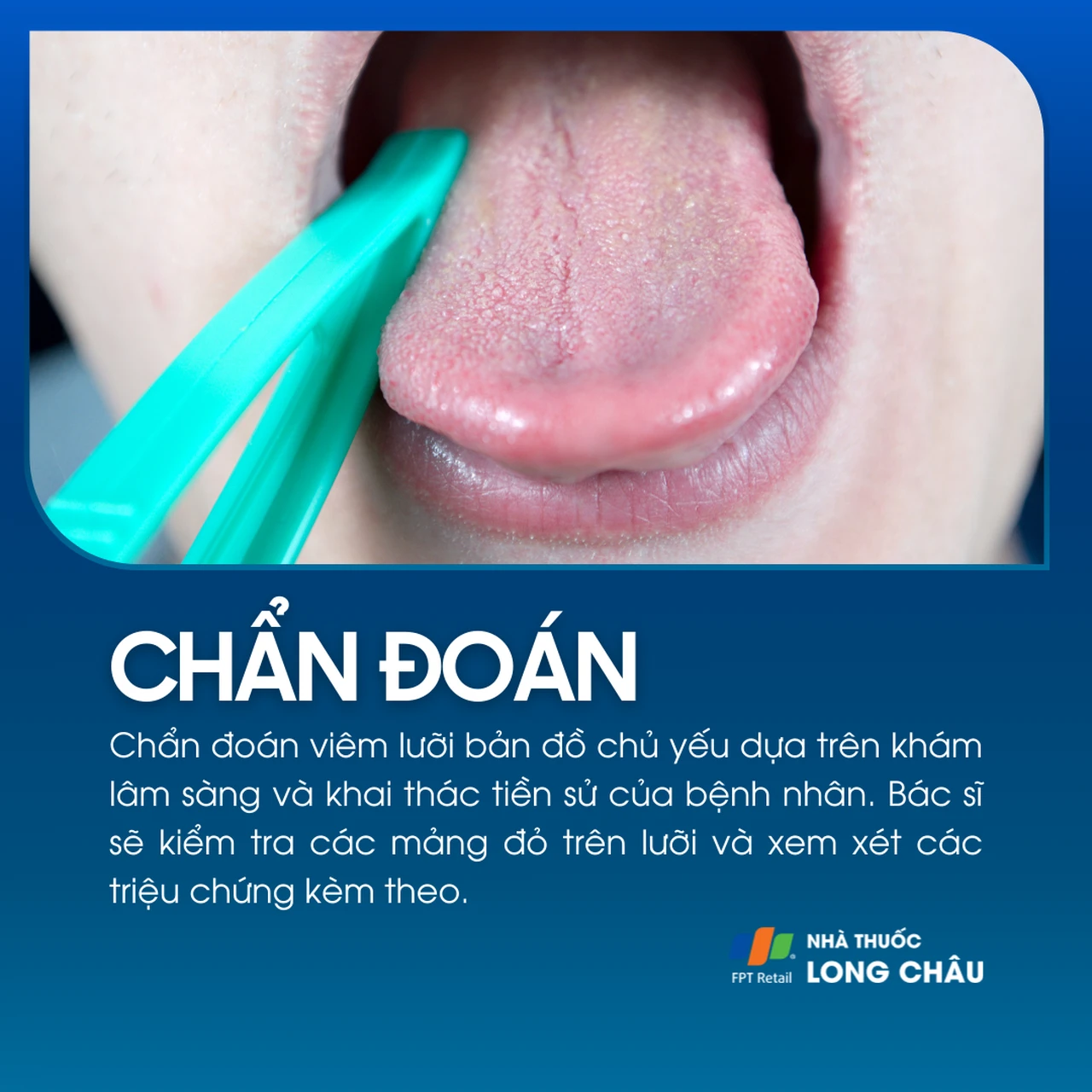 Viêm lưỡi bản đồ 5