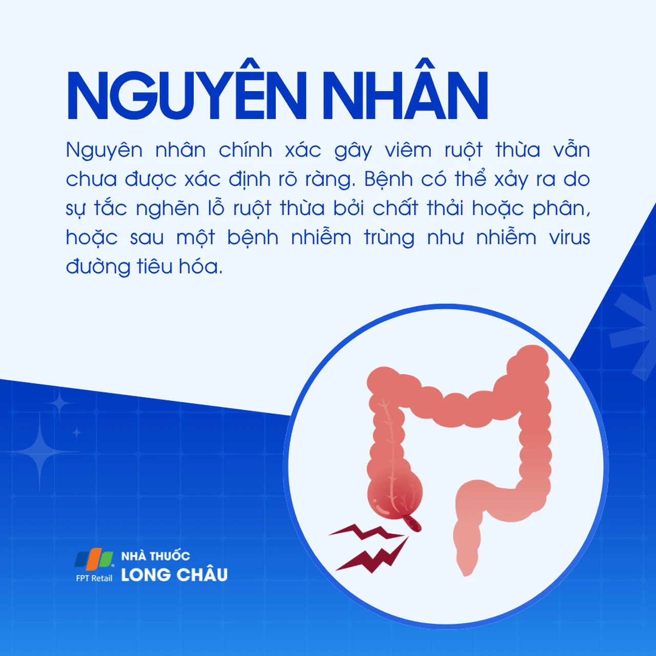 Viêm ruột thừa 3