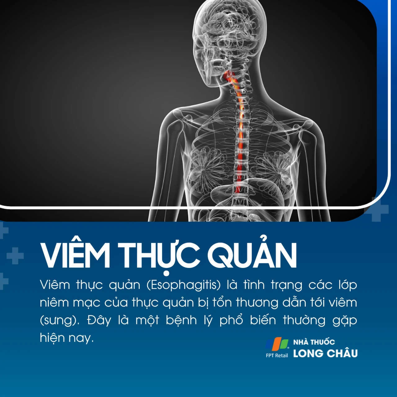 Viêm thực quản 1