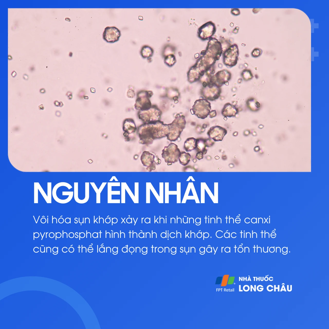 Vôi hóa sụn khớp 3