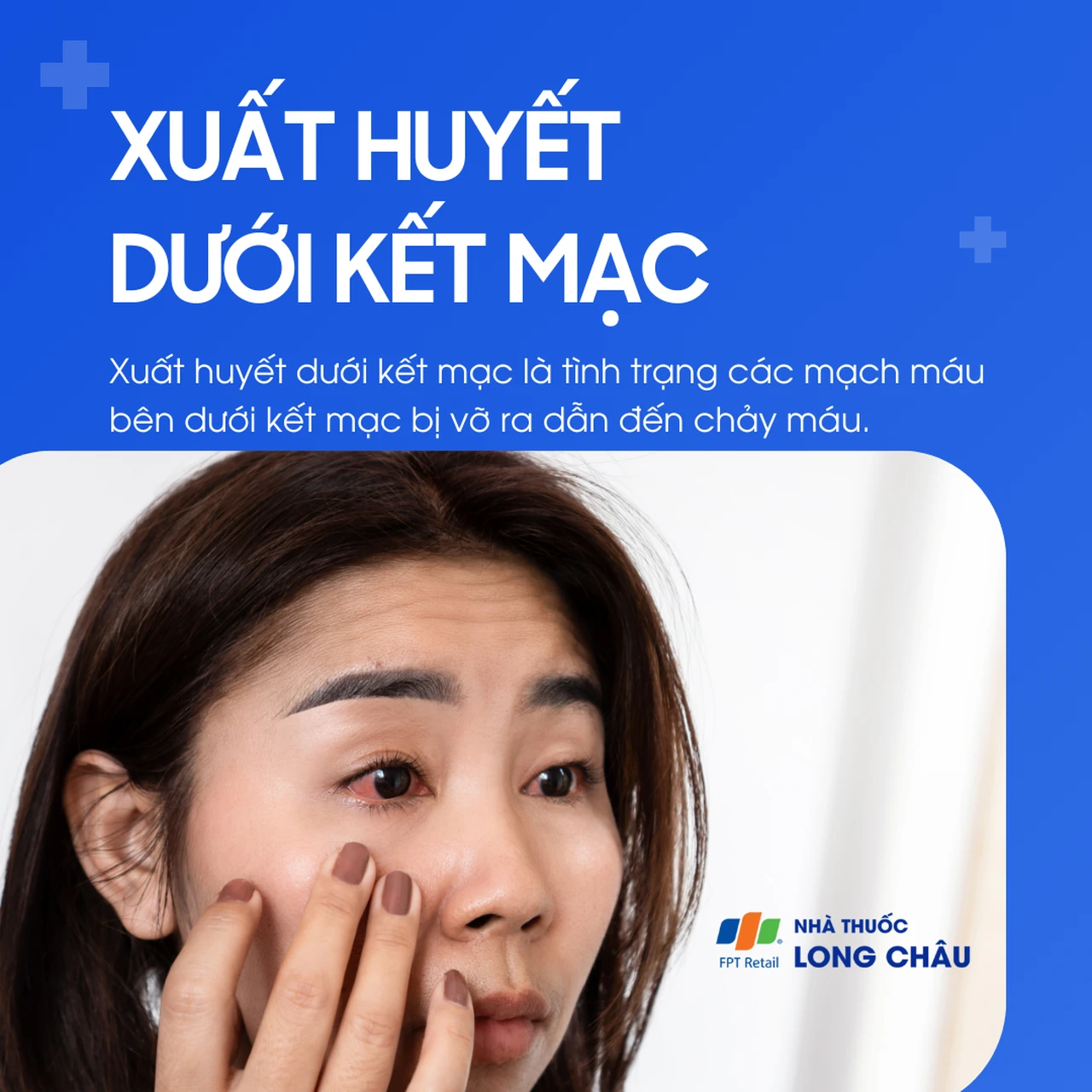 Xuất huyết dưới kết mạc 1