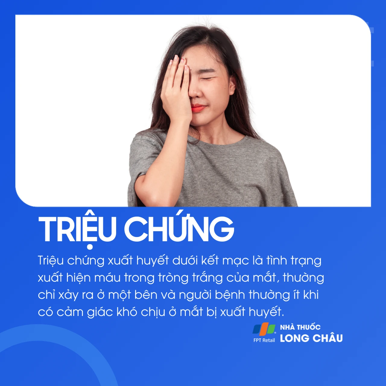 Xuất huyết dưới kết mạc 2