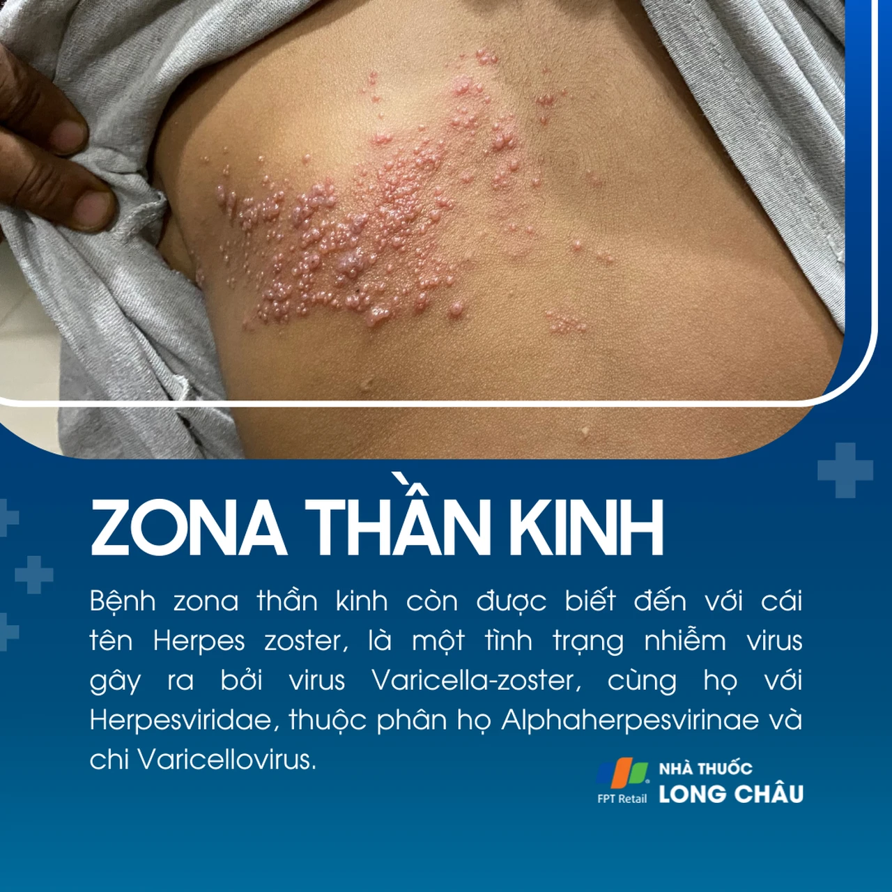 Bệnh zona thần kinh do virus Varicella-zoster