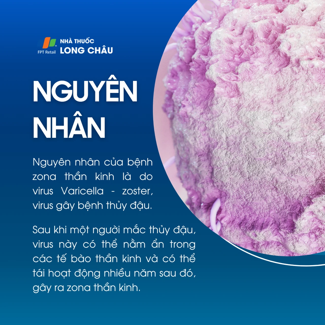Nguyên nhân bệnh zona thần kinh do virus thủy đậu tái hoạt động