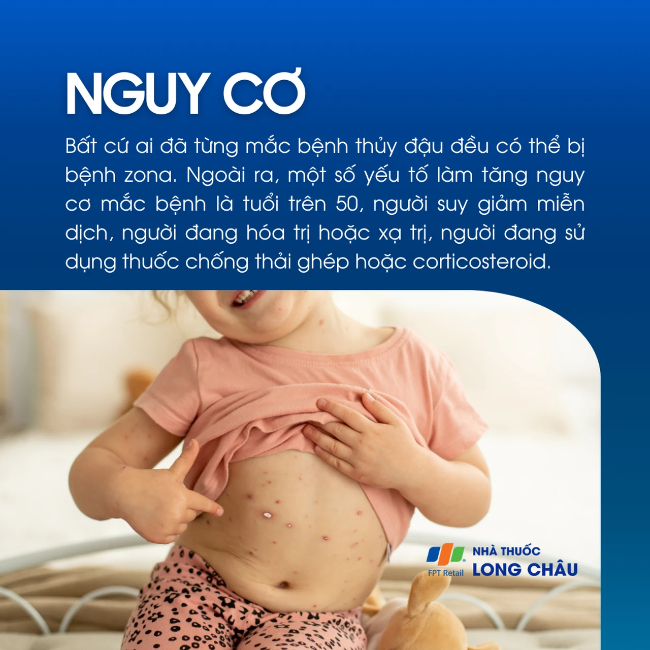 Nguy cơ mắc bệnh zona thần kinh ở người từng bị thủy đậu