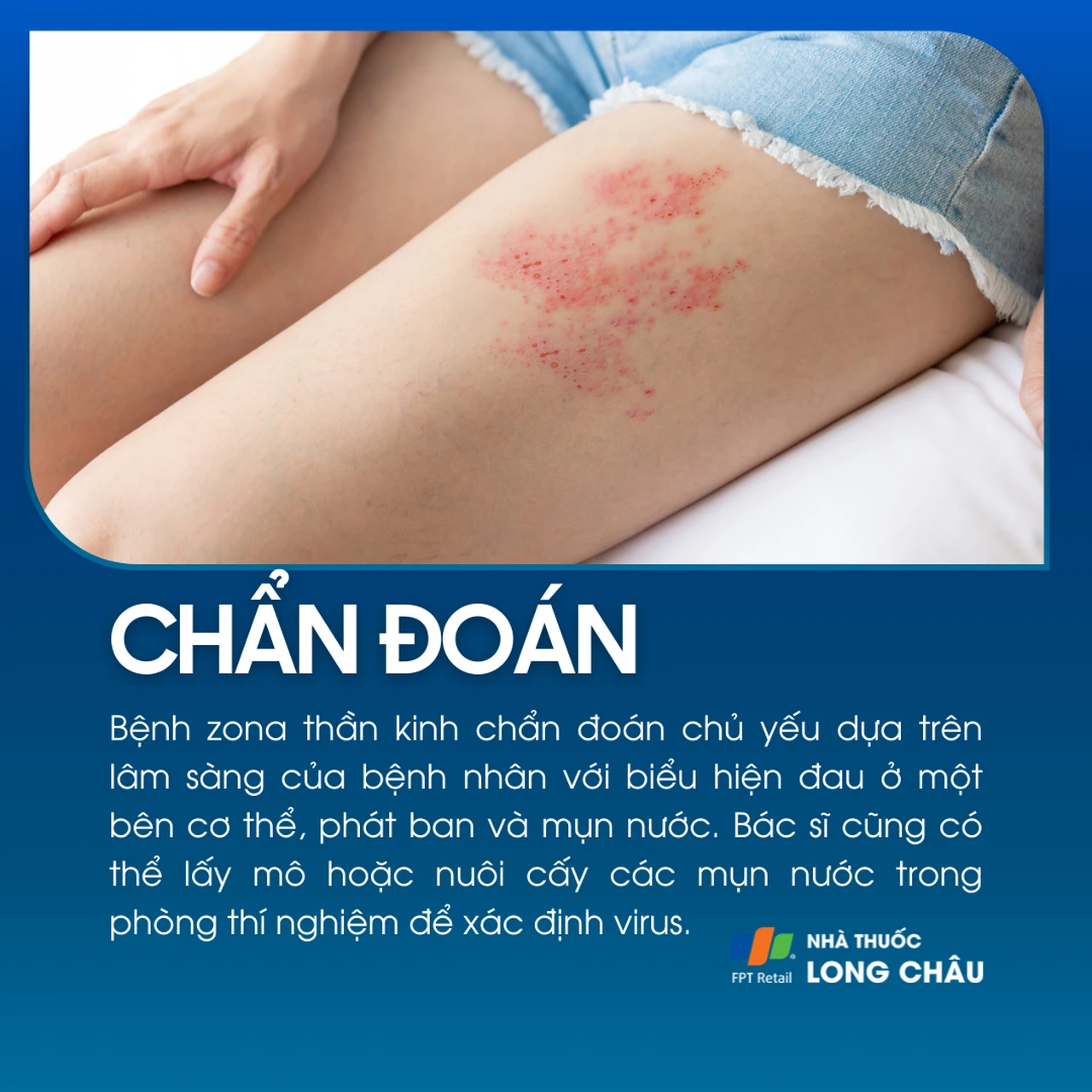 Chẩn đoán bệnh zona thần kinh qua biểu hiện phát ban