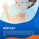 Rôm sảy là gì? Nguyên nhân, dấu hiệu và cách trị