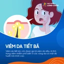 Viêm da tiết bã: Nguyên nhân và cách điều trị hiệu quả