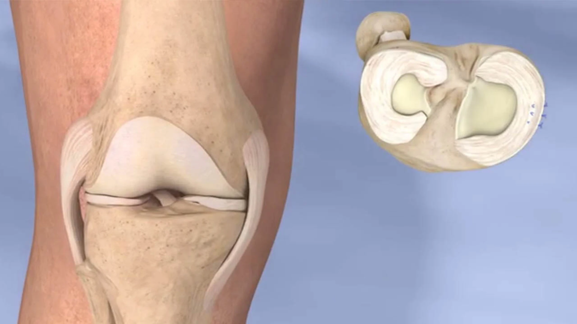 Rách sụn chêm khớp gối: Nguyên nhân và cách điều trị