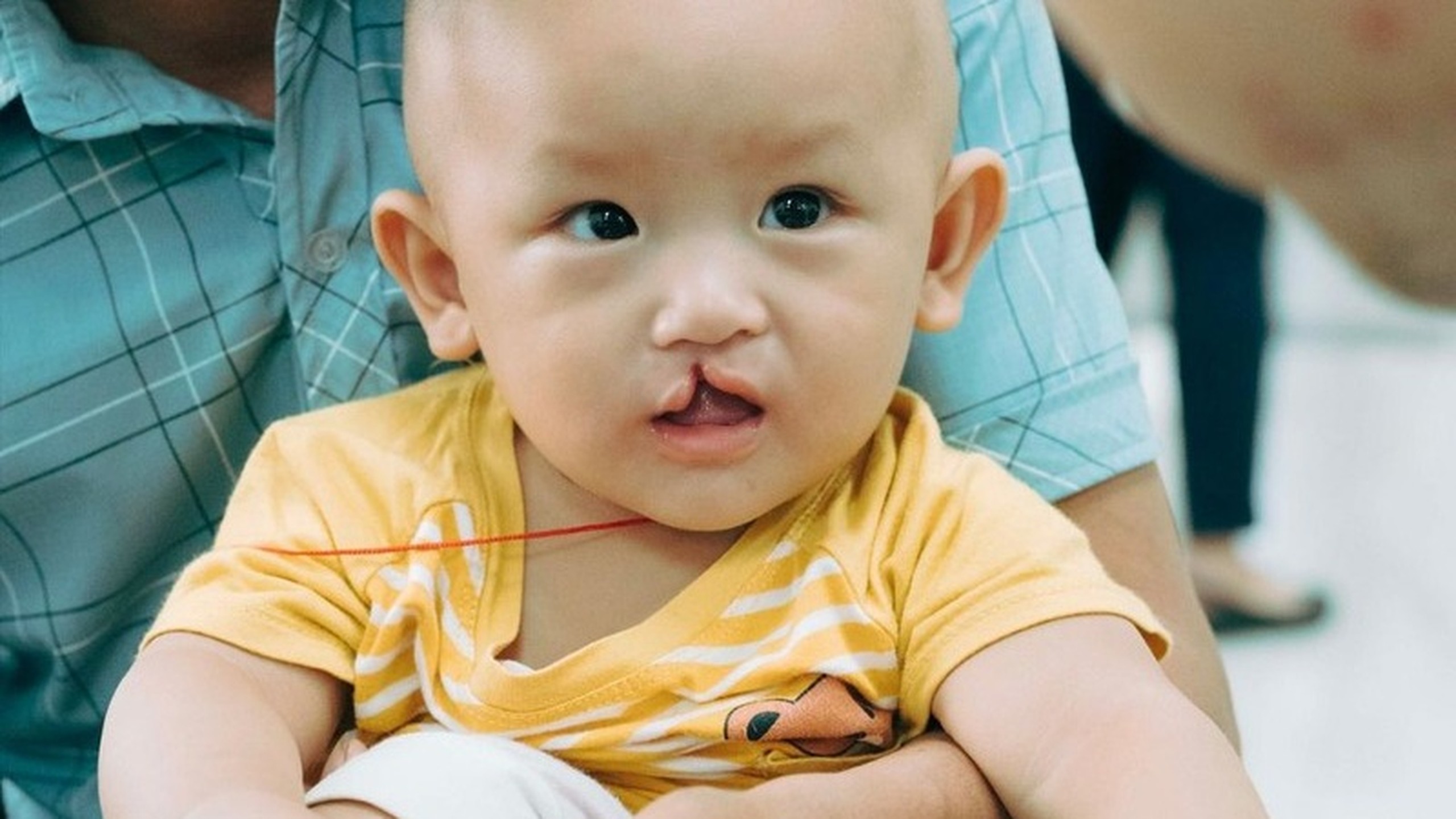 Trẻ bị sứt môi 4mm phải khắc phục như thế nào? 