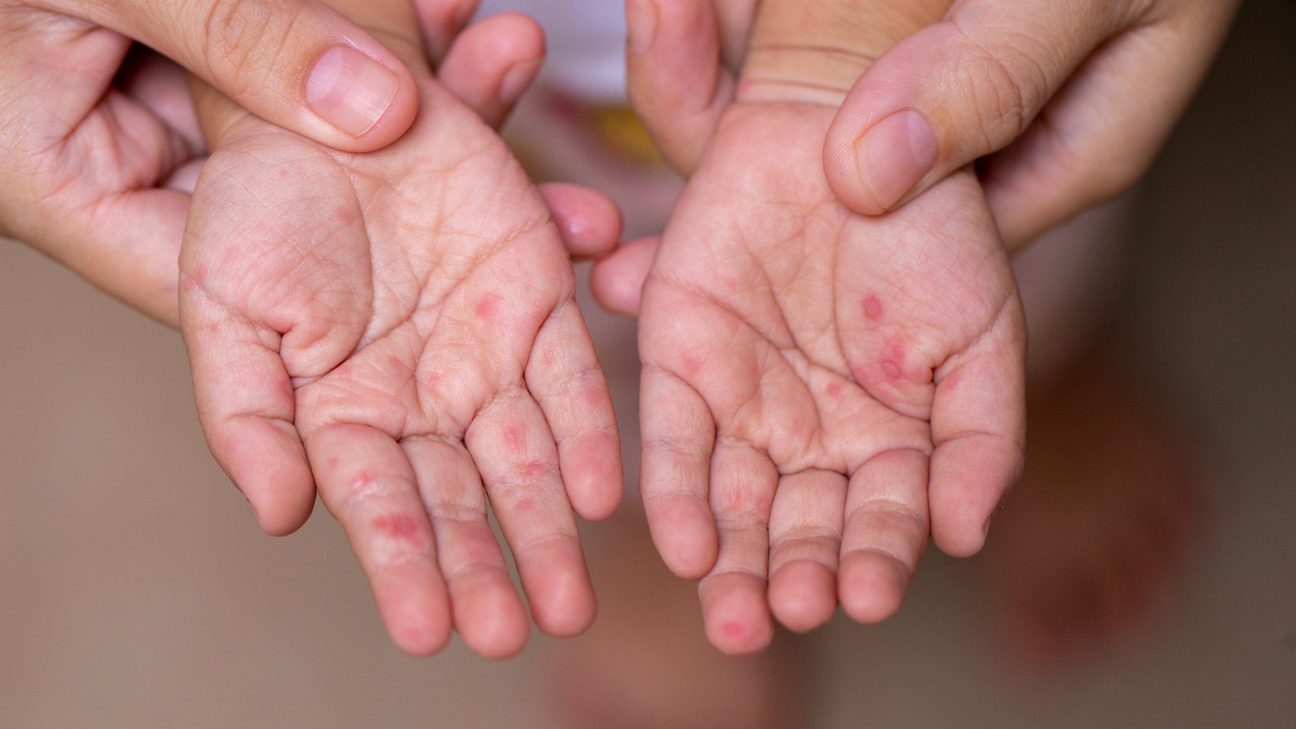 Bệnh tay chân miệng khi nào hết lây? Thời điểm lây bệnh nặng nhất