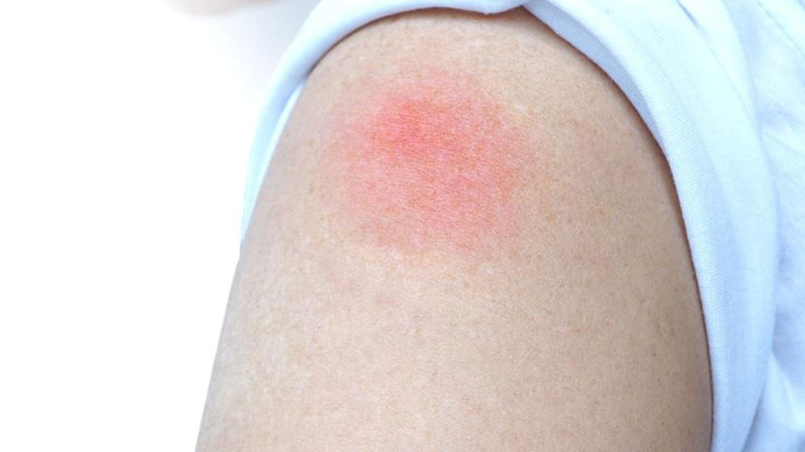 Biến chứng sau tiêm chủng: Những điều cần biết