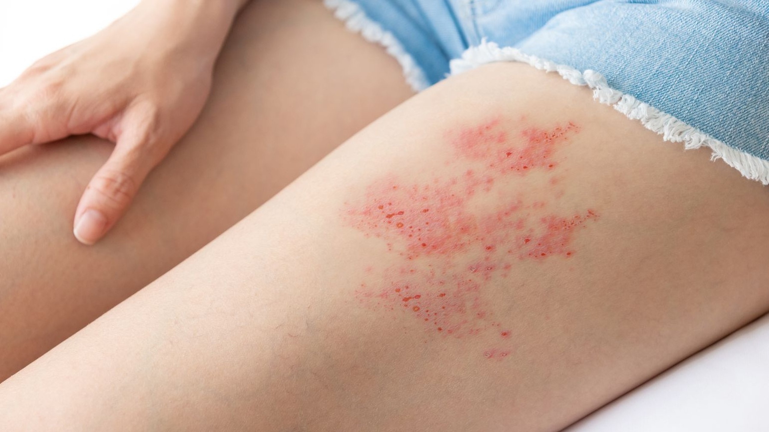 Cách dùng thuốc bôi zona thần kinh acyclovir