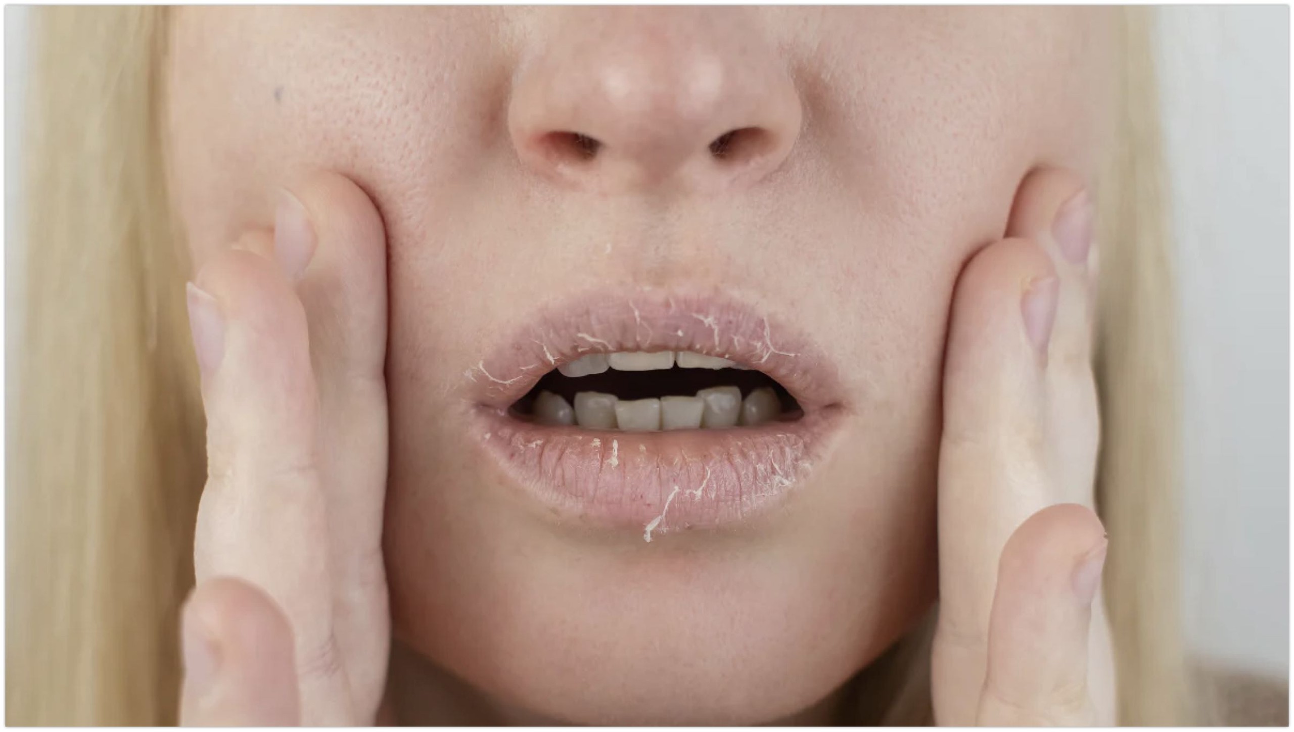 Mách bạn cách trị môi khô bong tróc 0