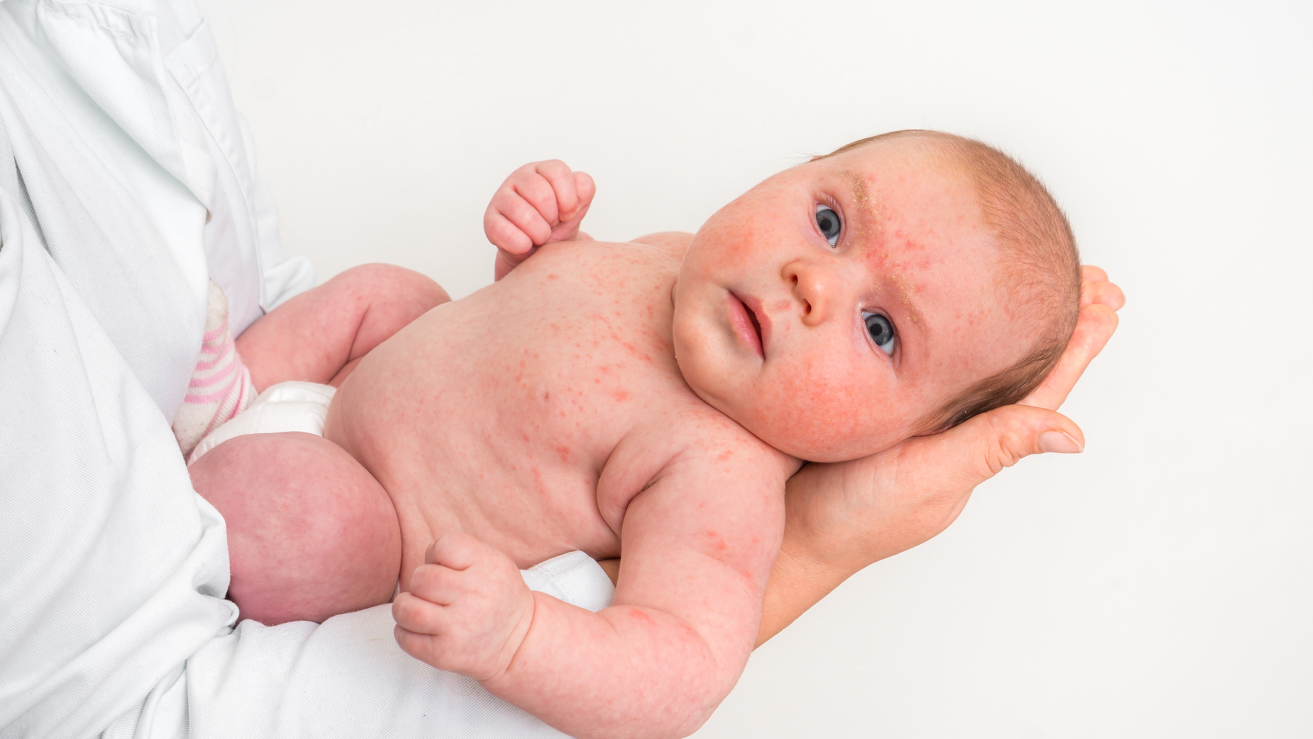 Cách trị rôm sảy cho bé​ hiệu quả mà mẹ nên biết