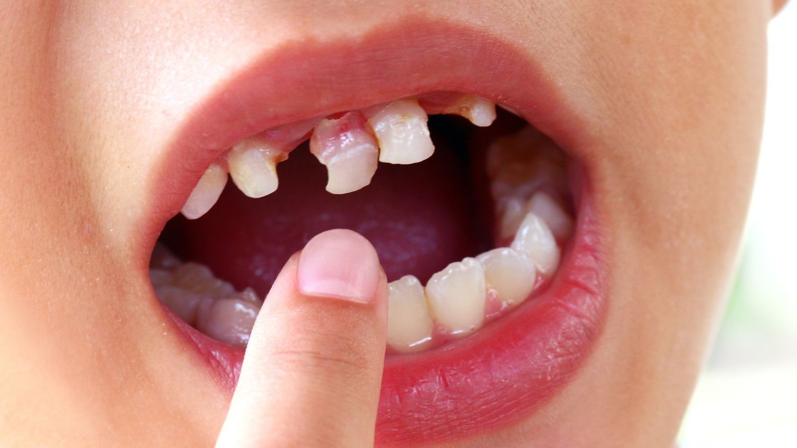 Chấn thương miệng ở trẻ em: cách nhận biết và xử lý hiệu quả