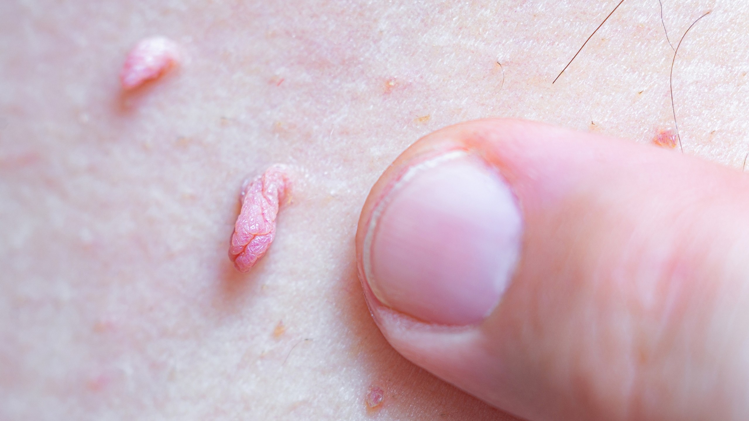 Dấu hiệu nhận biết sùi mào gà giai đoạn đầu và cách xử lý sớm