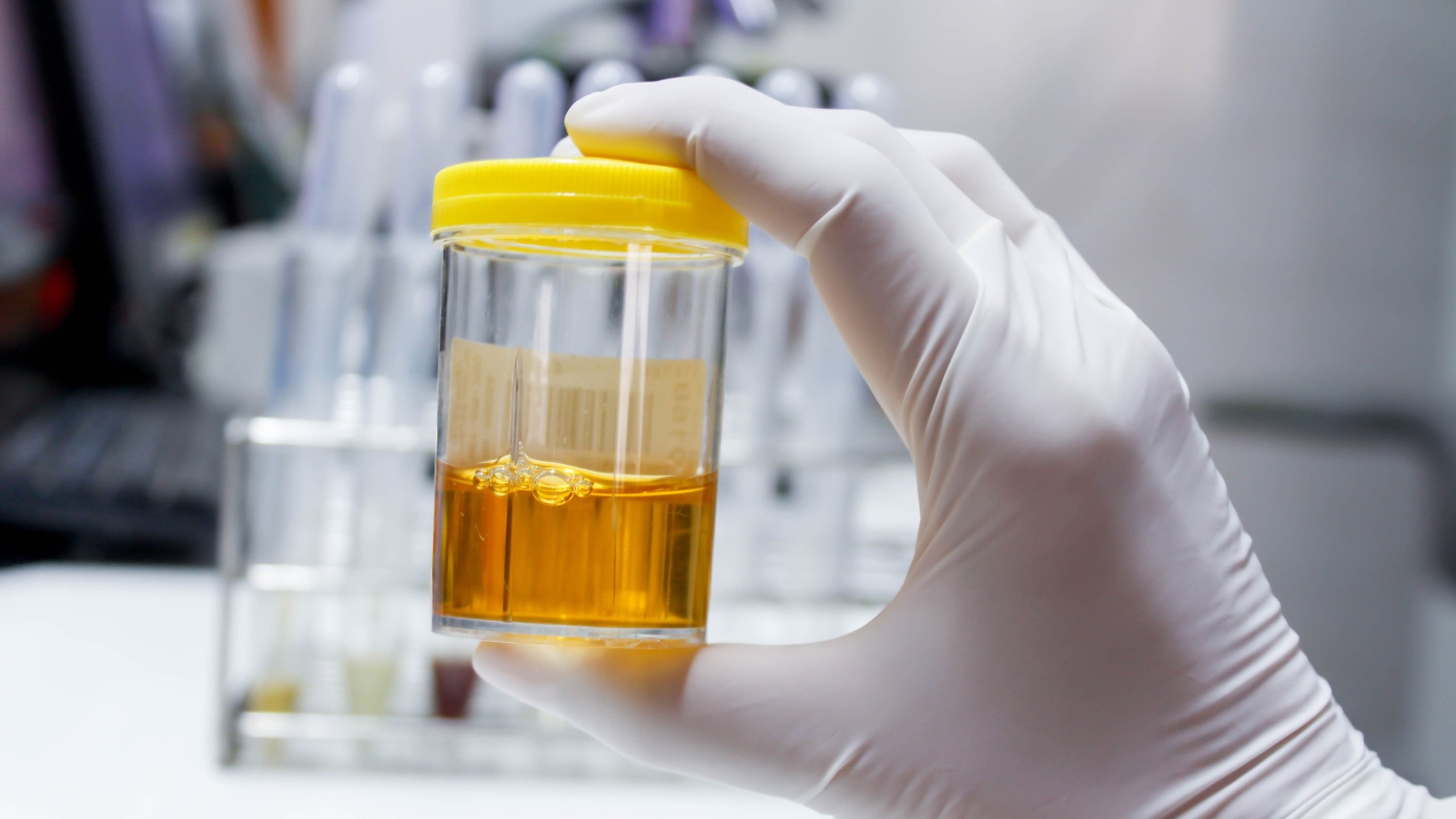 Định lượng protein niệu là gì? Các phương pháp xét nghiệm protein niệu thường dùng