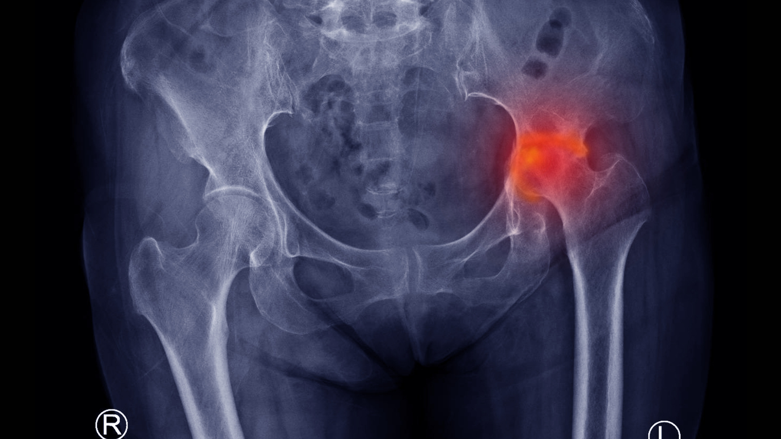 Hoại tử khớp háng: Nguyên nhân, triệu chứng và phương pháp chẩn đoán 0