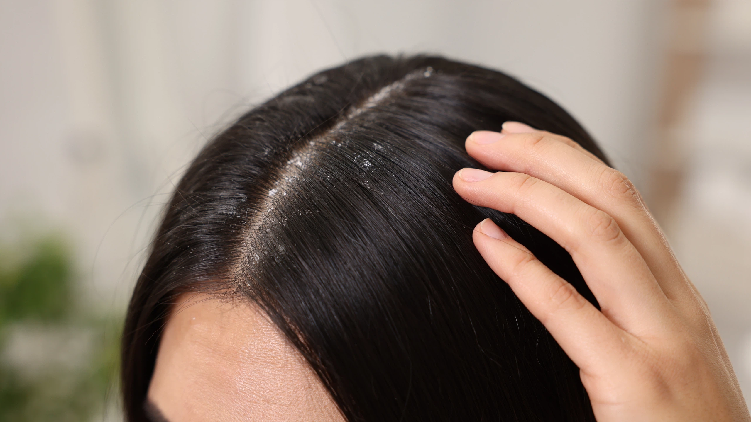 13 cách trị gàu ngứa dứt điểm mùa nắng nóng 0