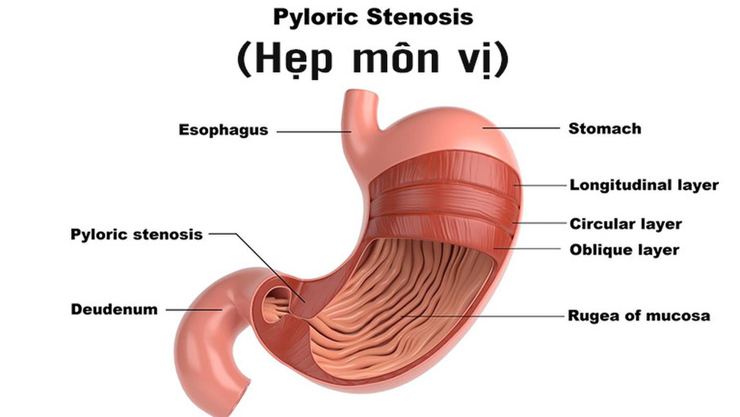 Hội chứng hẹp môn vị là gì? Nguyên nhân và cách điều trị + 1
