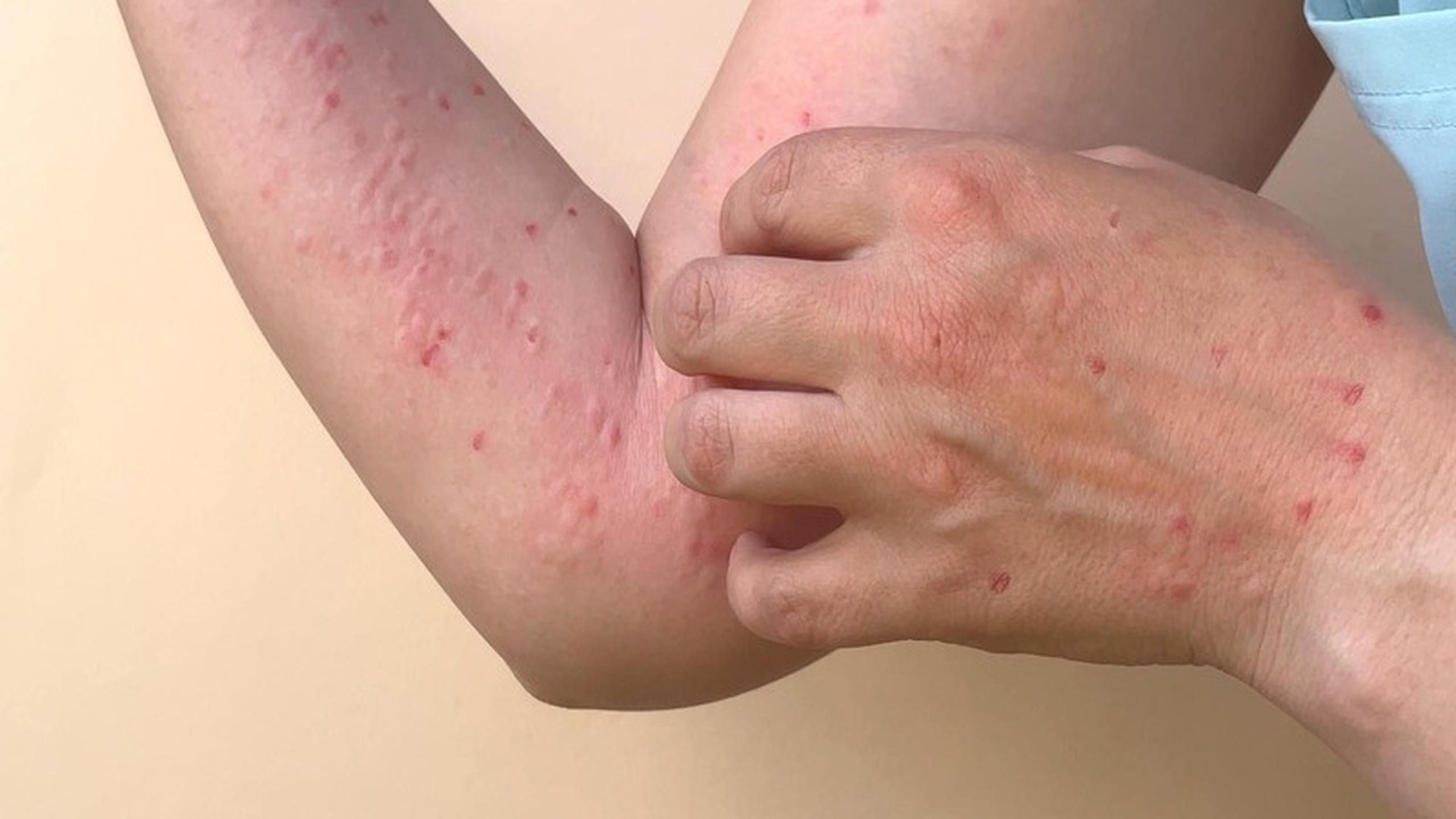 Aplastic anemia là gì? Những biến chứng thường gặp