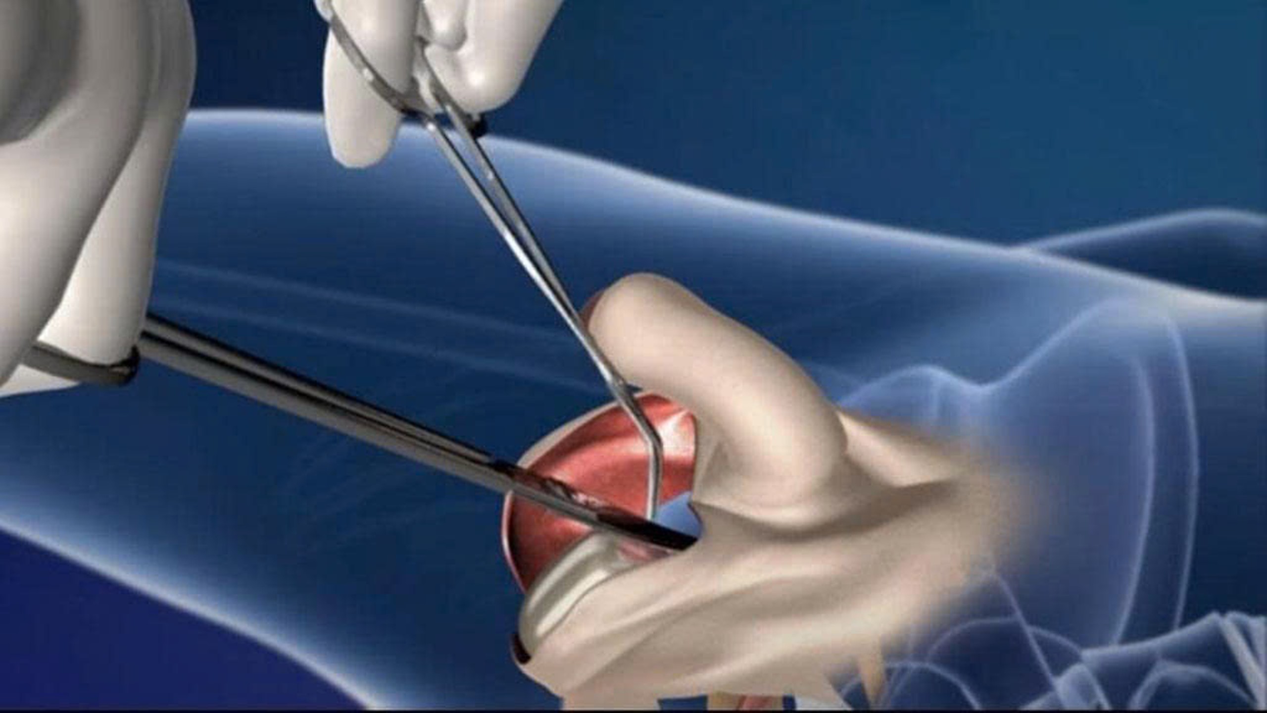 Bao quy đầu trẻ em bình thường phát triển như thế nào? 