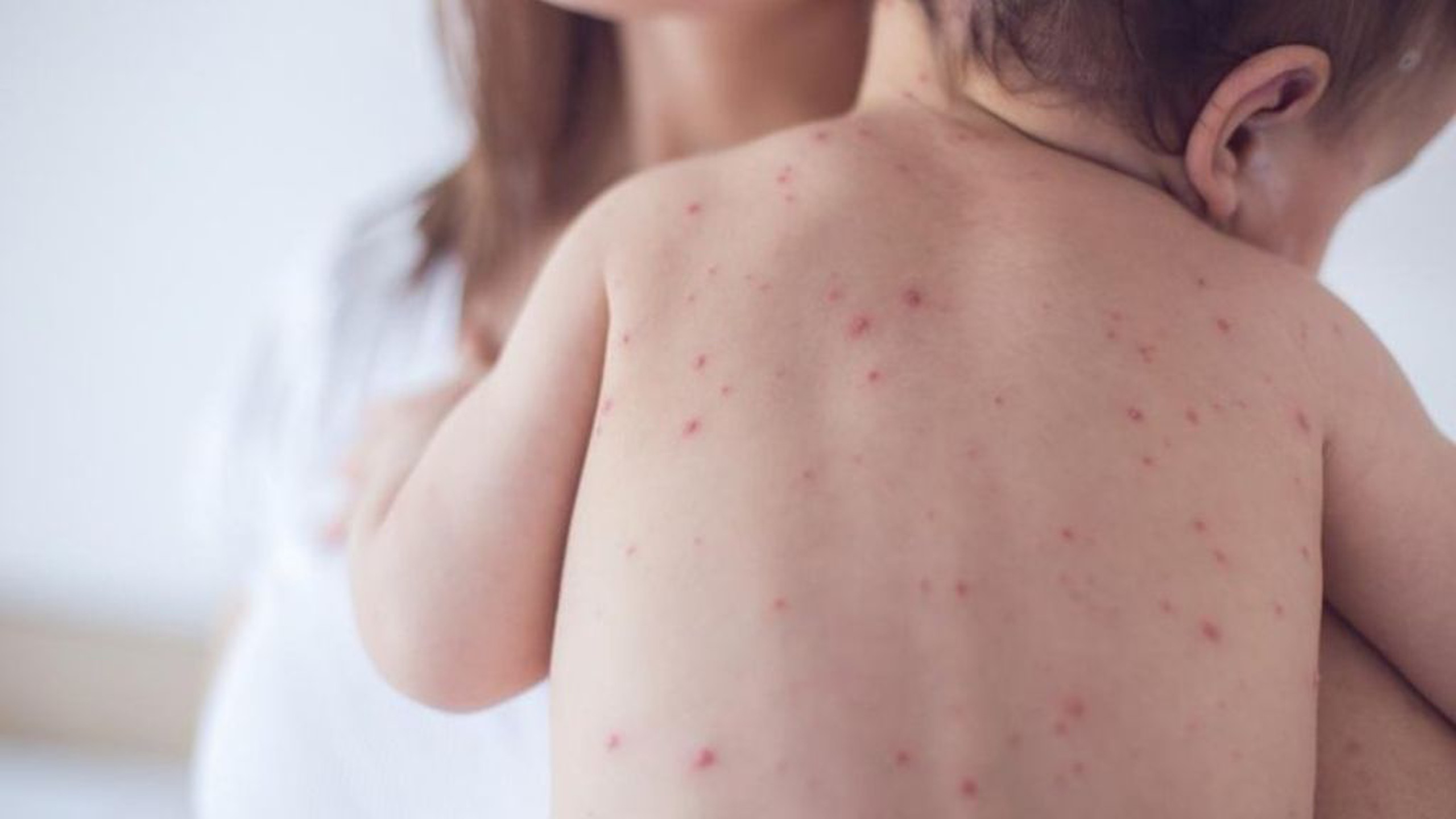 Bệnh sởi có bị lây không? Phòng bệnh thế nào? 0