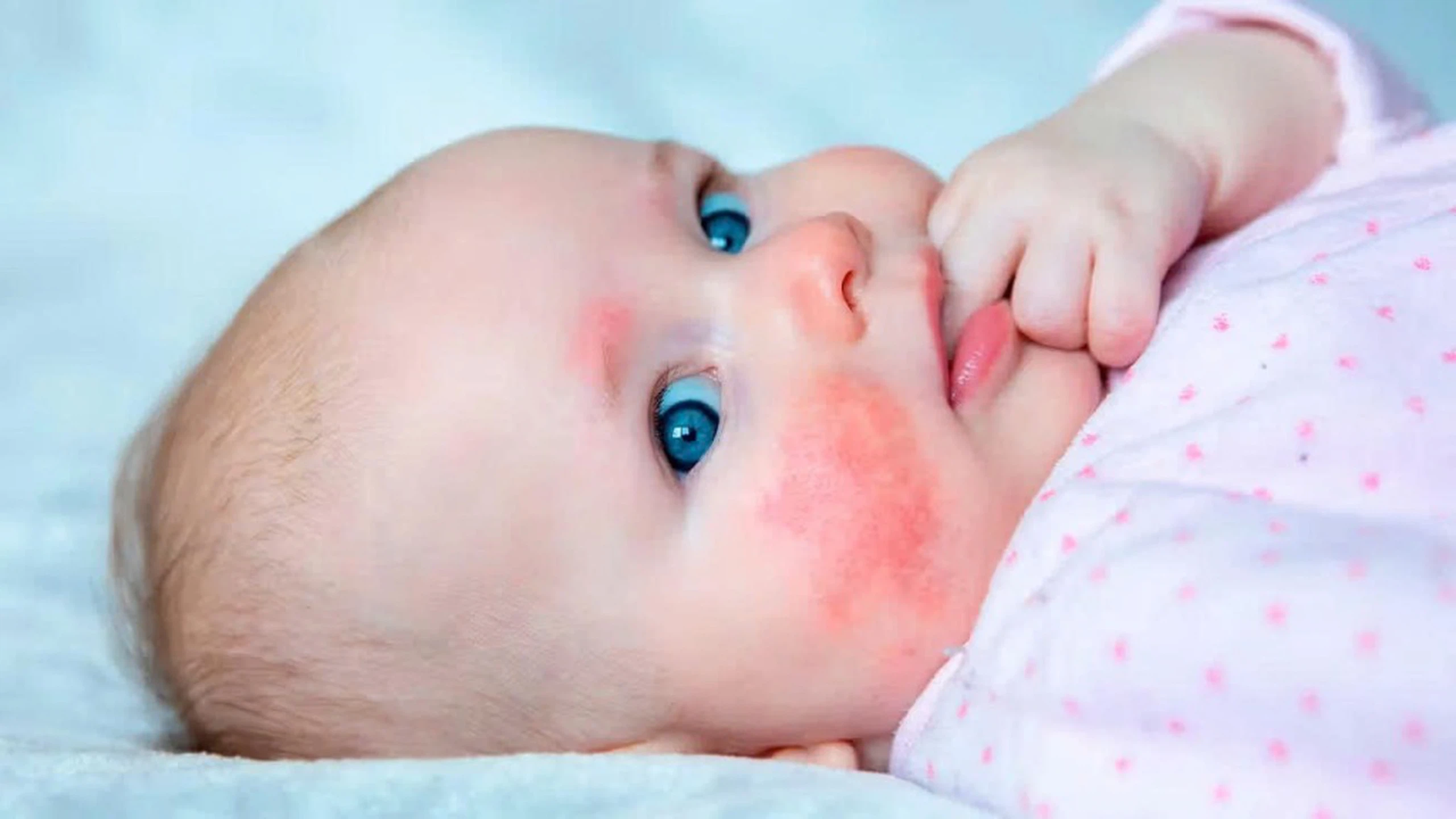 Dị ứng đạm sữa bò là gì? Nguyên nhân, triệu chứng và cách khắc phục 0