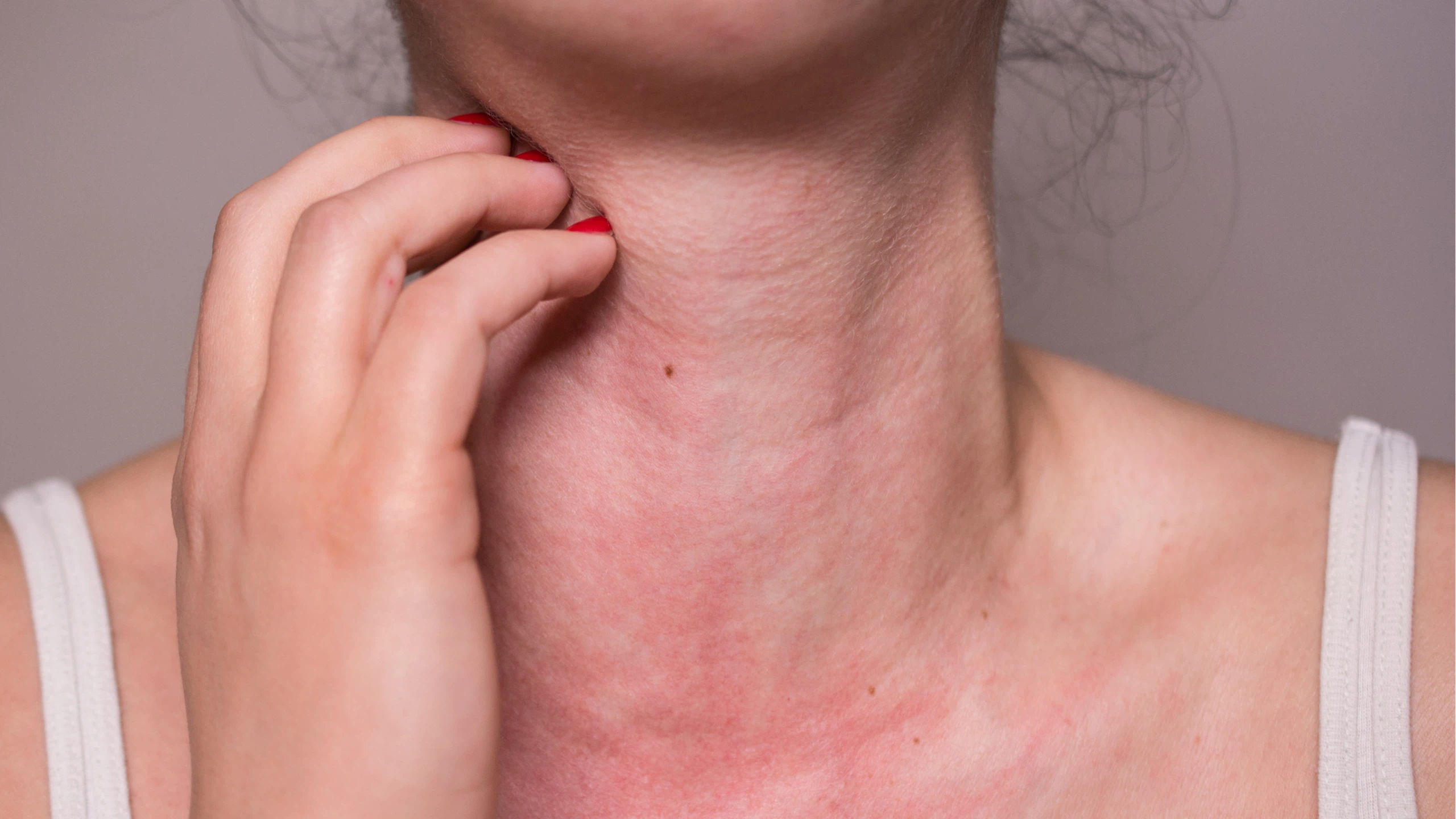 Dị ứng thời tiết là gì? Cách điều trị dị ứng thời tiết 0