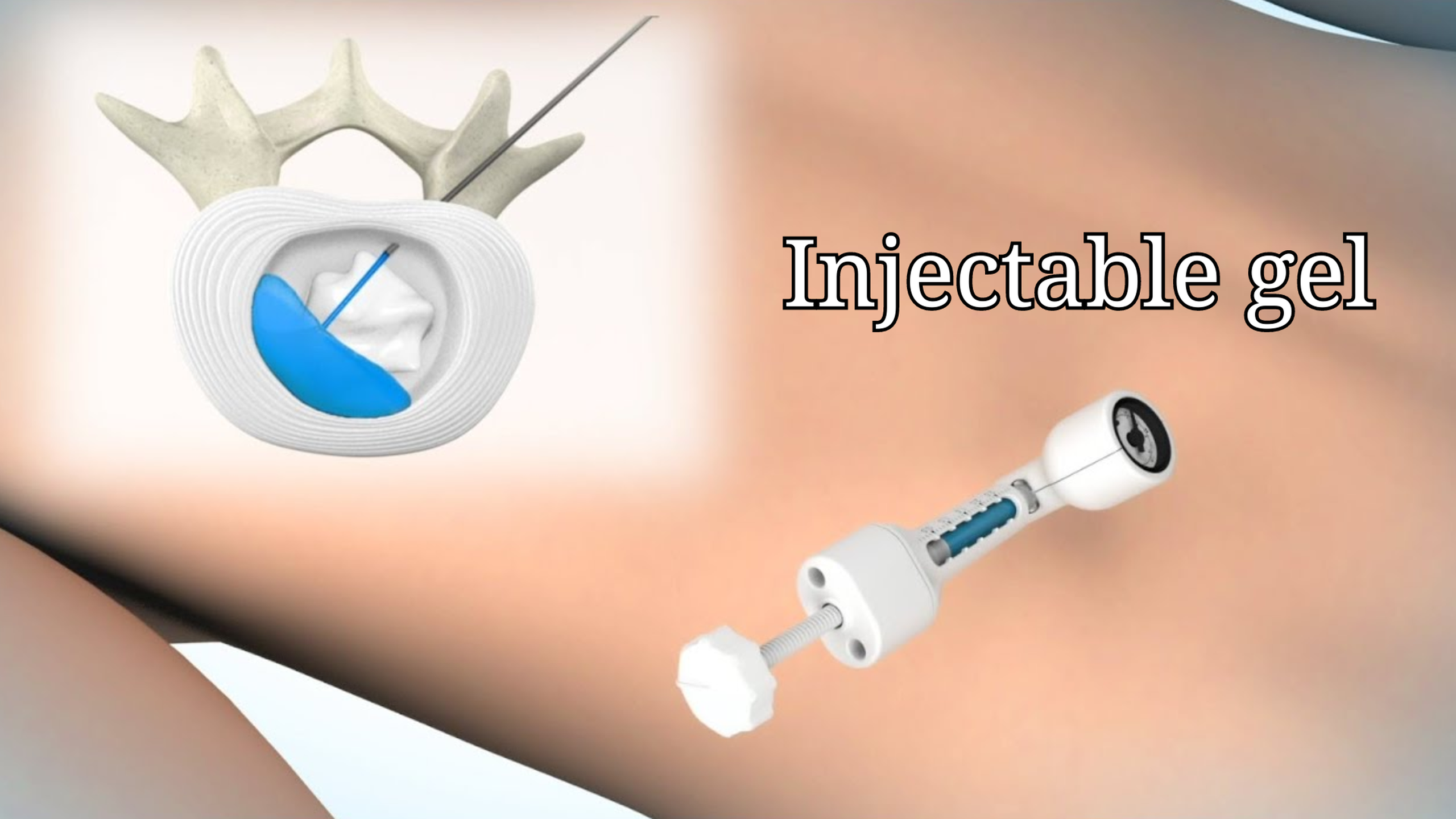 Gel tiêm có thể giúp điều trị chứng đau lưng thoái hóa 1