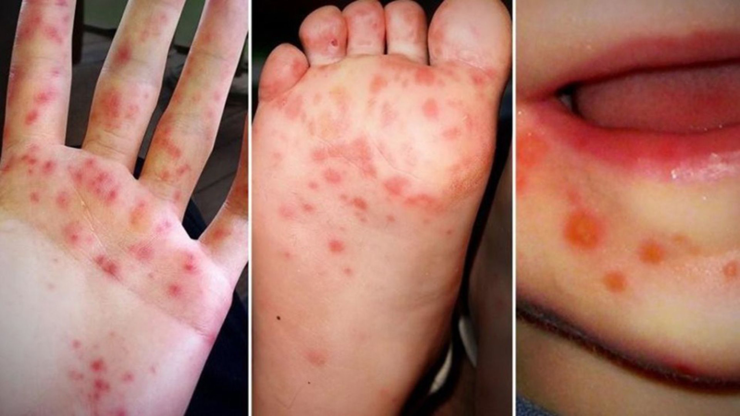 Hướng dẫn vệ sinh cho trẻ bị tay chân miệng đúng cách để phòng ngừa lây lan