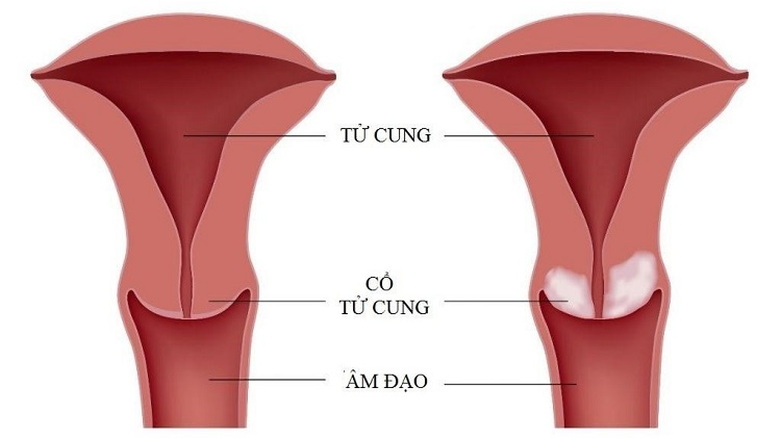 Khám ung thư cổ tử cung gồm những gì và nên khám khi nào?