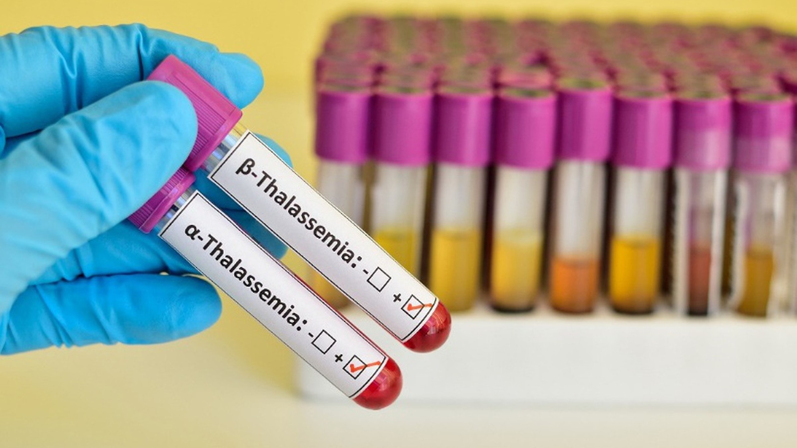 Mang gen thalassemia có nên uống sắt không? Những điều cần chú ý khi mang gen thalassemia