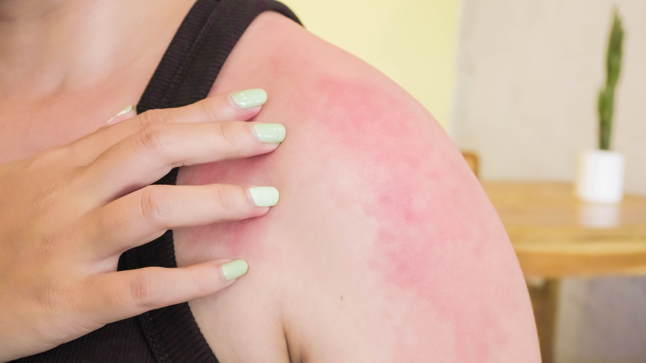 Một số dấu hiệu nhận biết các loại dị ứng da thường gặp 