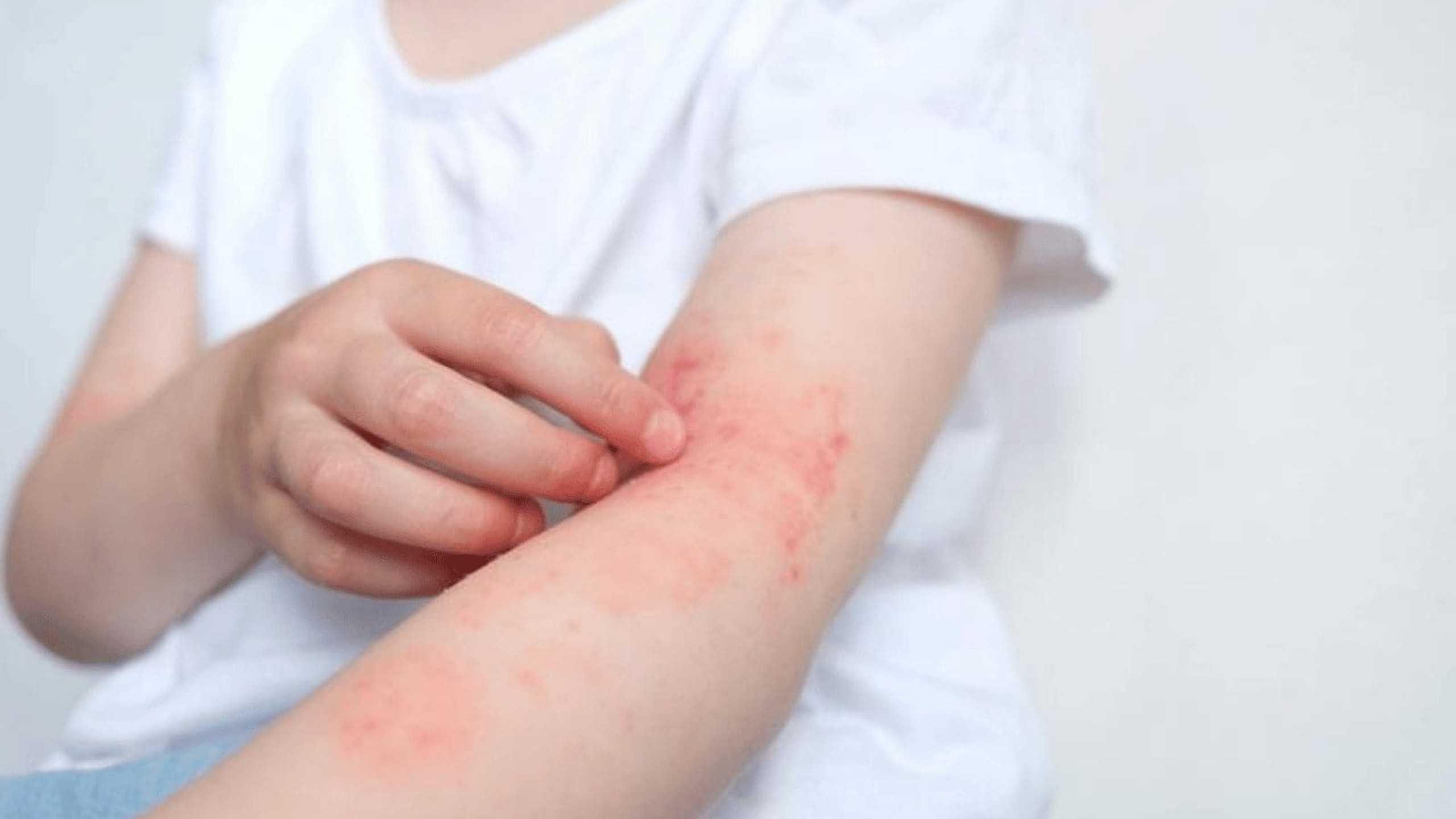 Nhiễm sán chó có nguy hiểm không? Hướng dẫn cách phòng ngừa