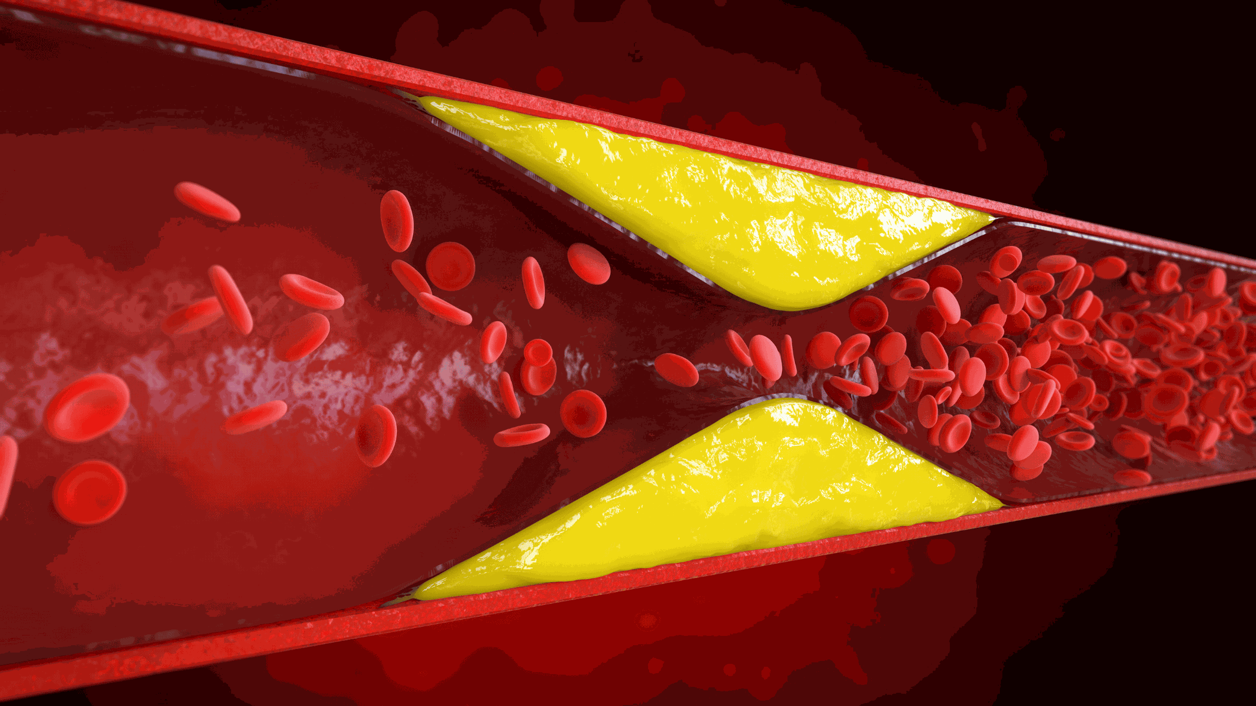 Nhồi máu động mạch mạc treo là gì? Những thông tin cần biết