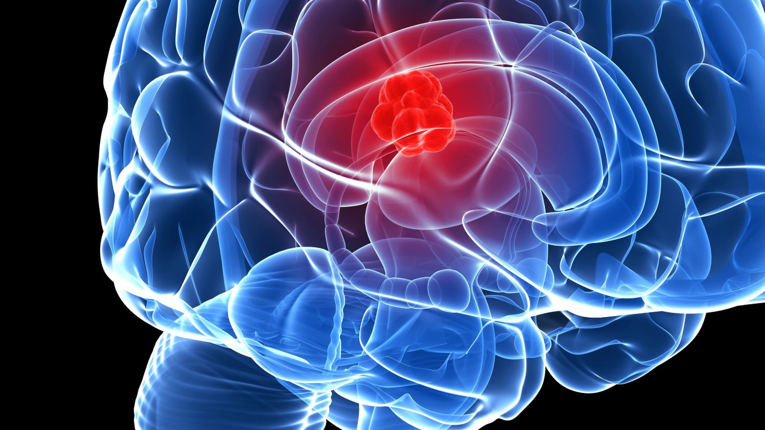 Nhầm lẫn giữa polyp não và u não: Giải thích rõ khái niệm và phương pháp chẩn đoán