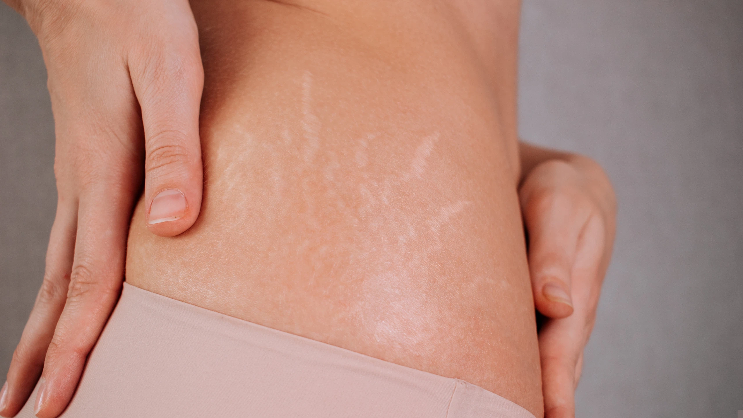 Phân biệt các loại rạn da thường gặp