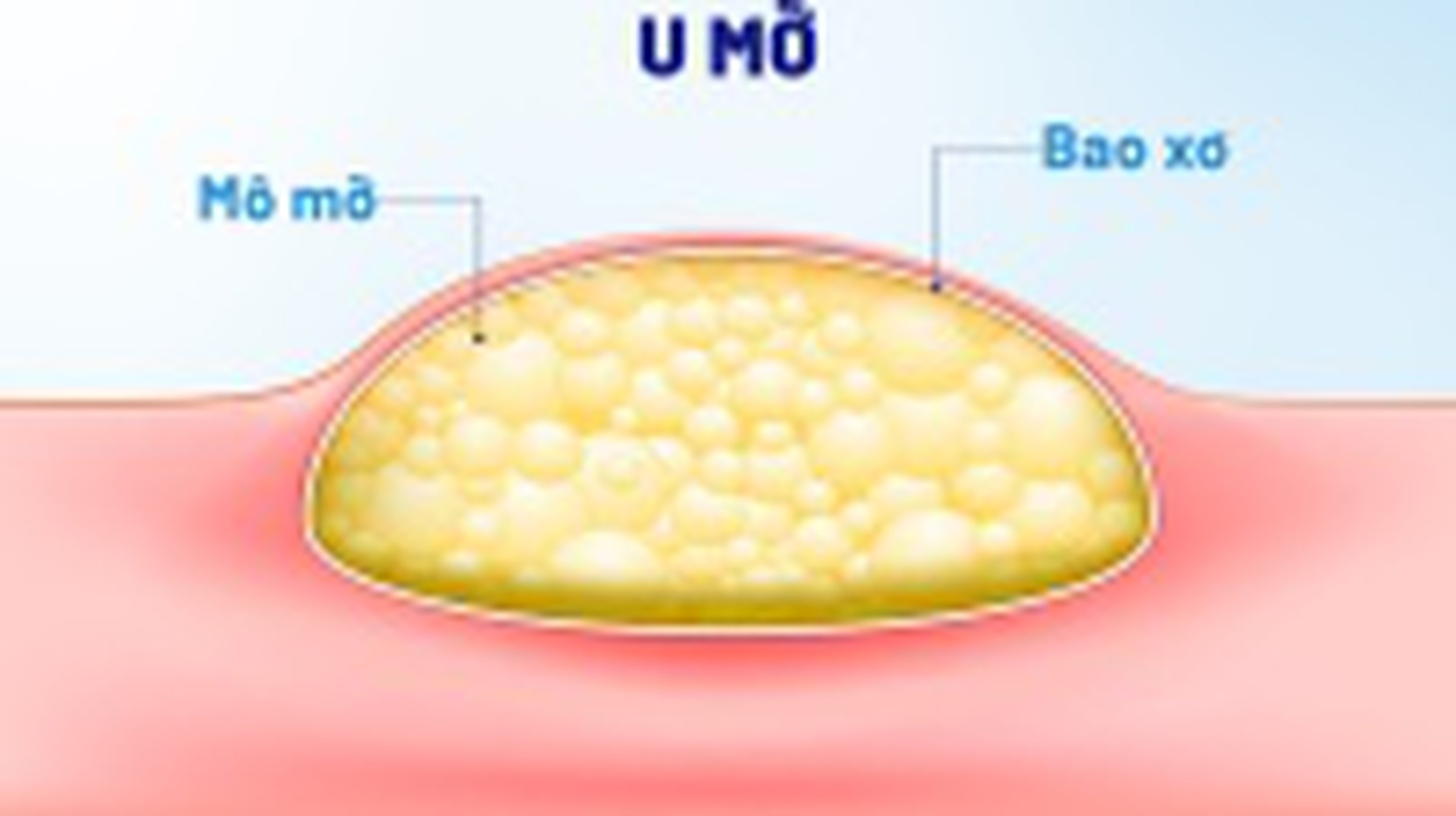 U mỡ ở bụng là gì? Có nguy hiểm không? 3