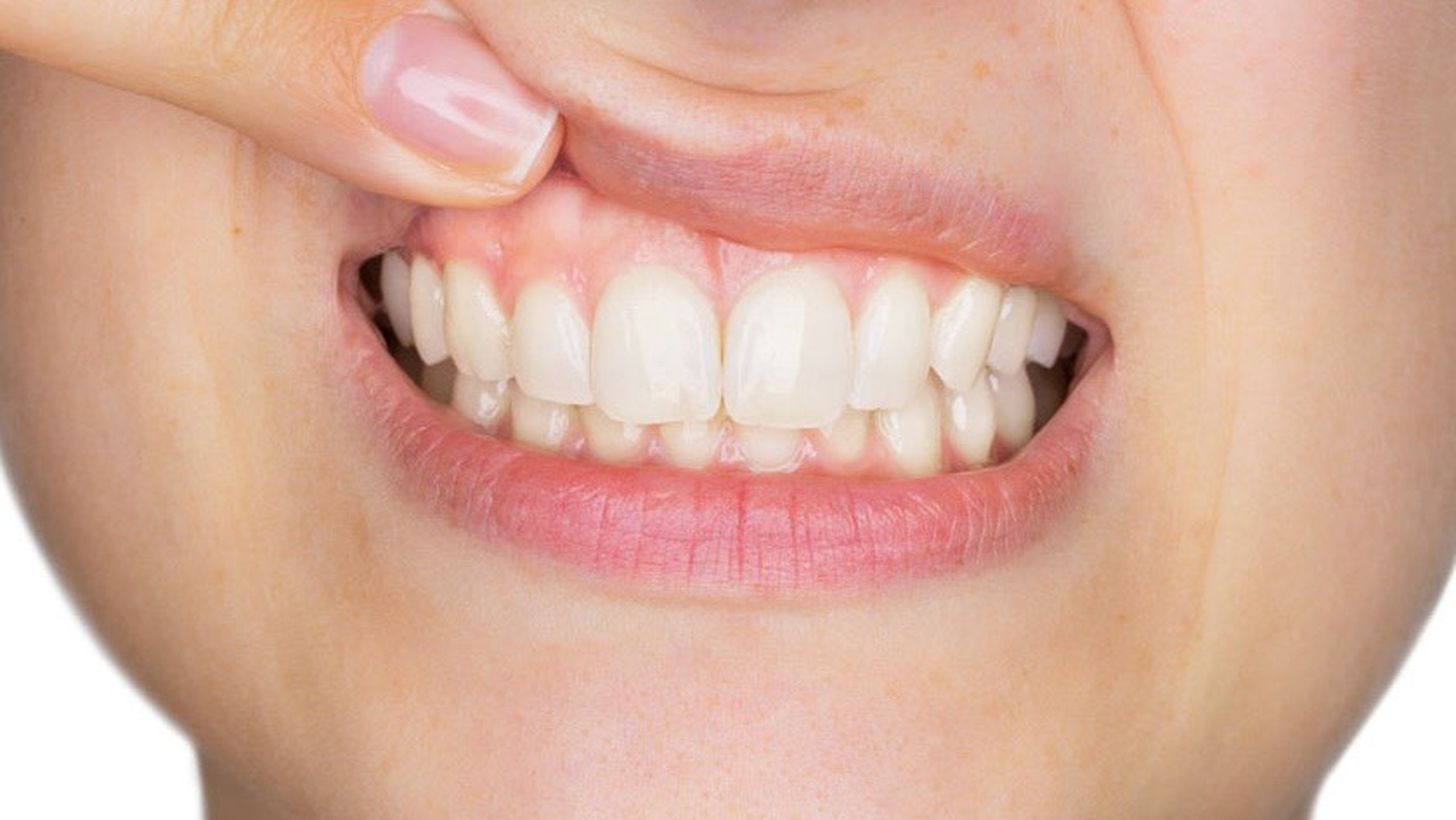 Tình trạng lợi chân răng bị trắng là biểu hiện của những bệnh lý nào?