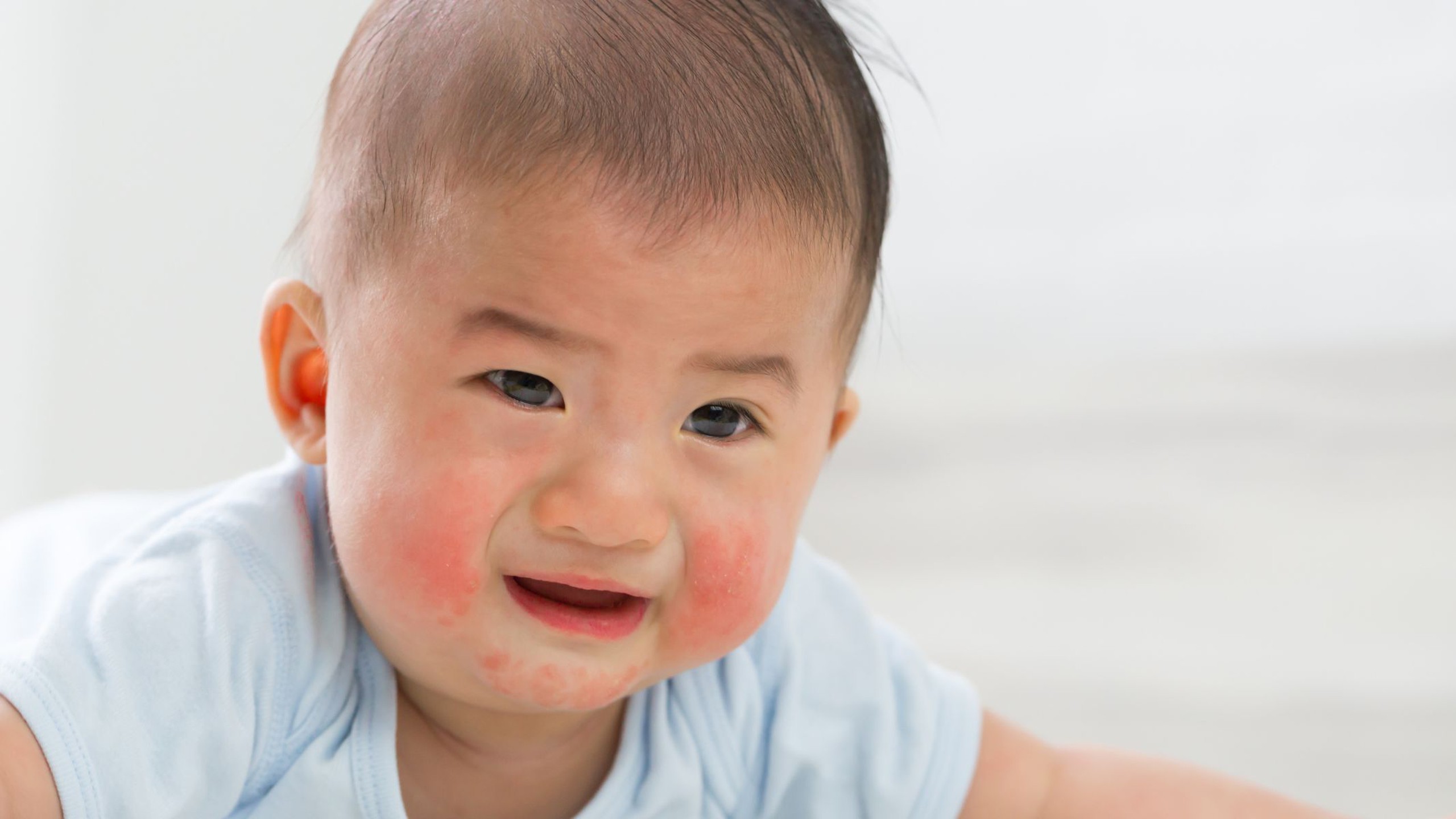 Triệu chứng Lupus ban đỏ ở trẻ em: Dấu hiệu cảnh báo cha mẹ không nên bỏ qua