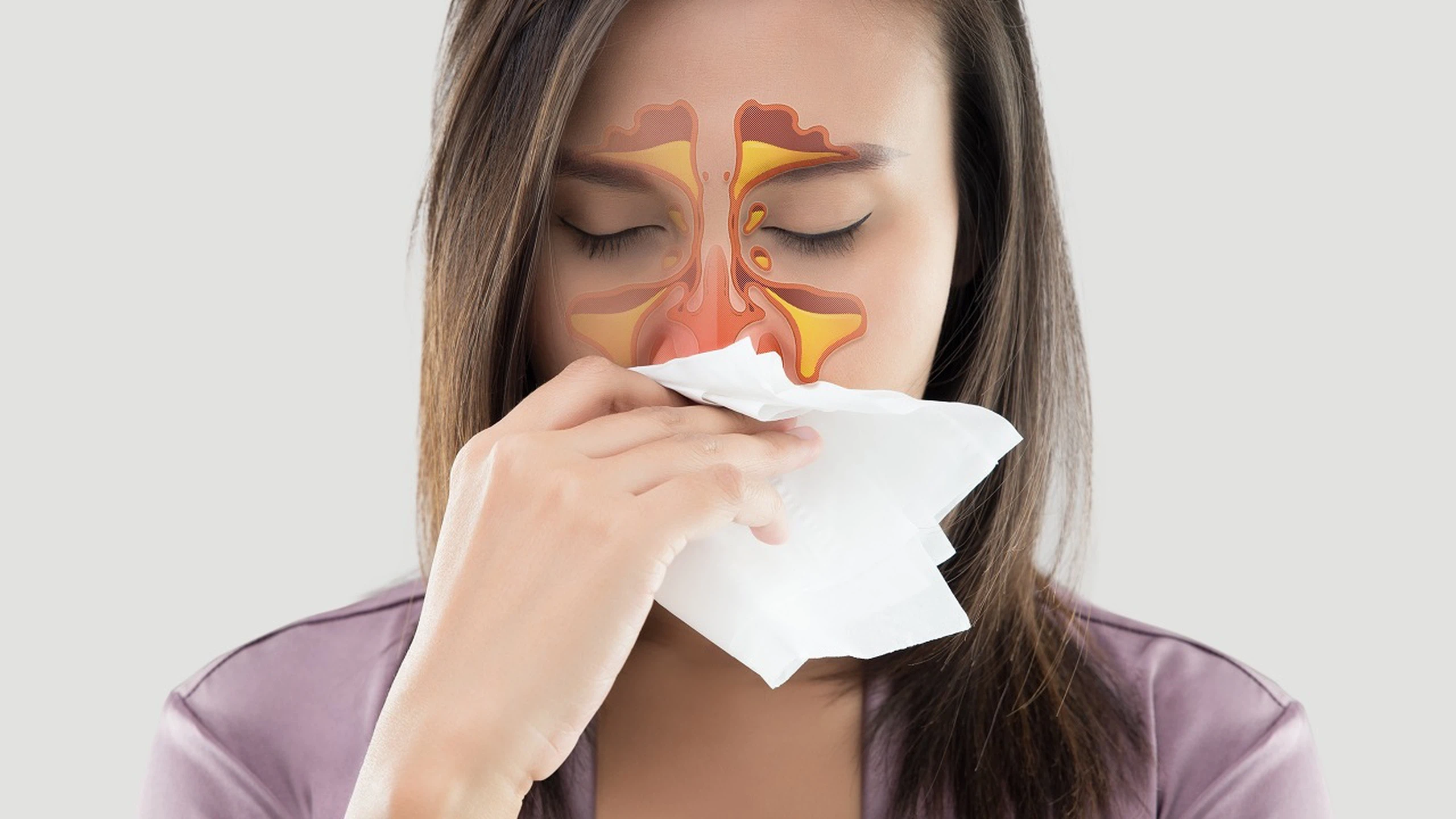 Viêm xoang cấp: Nguyên nhân, triệu chứng và phương pháp điều trị
