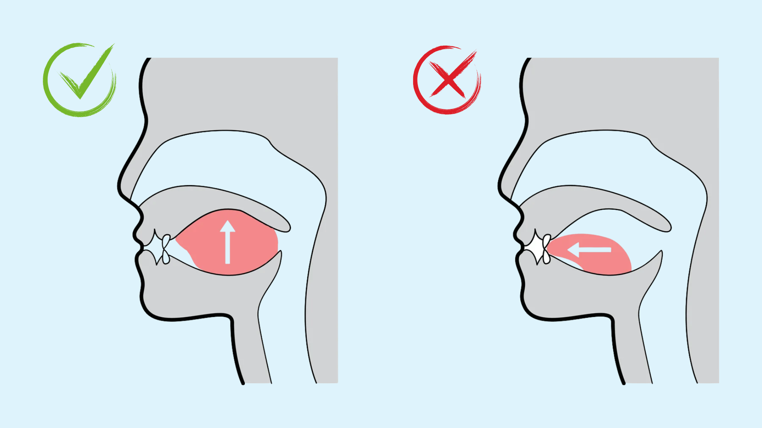 Mewing là gì? Hướng dẫn kỹ thuật và lợi ích sức khỏe răng hàm mặt